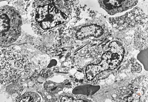 bone marrow - crystalloid inclusions Charcot-Leyden crystals formation bone marrow - crystalloid inclusions Charcot-Leyden crystals formation